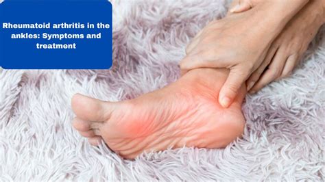Rheumatoid Arthritis In The Ankles Symptoms And Treatment