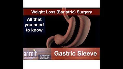 Obesity Weight Loss Bariatric Surgery Laparoscopic Gastric Sleeve