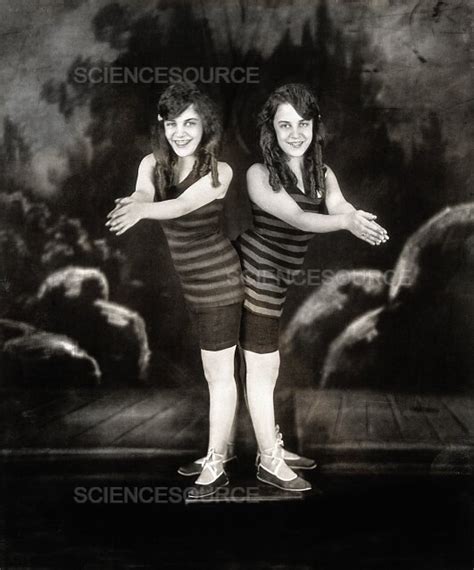 Photograph Daisy And Violet Hilton Conjoined Twi Science Source Images