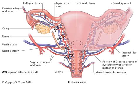 Uterine Ligaments Diagram