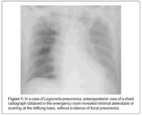 Legionnaires' disease, which is a severe form of pneumonia due to infection with legionella. air-water-borne-diseases-anteroposterior