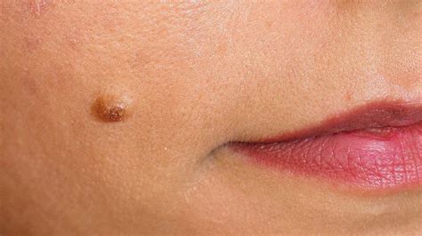 top 10 home remedies to remove skin tags naturally remedies lore