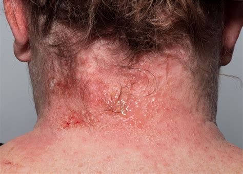 Due to this, irritation signs usually start appearing almost immediately or a few minutes later. Contact dermatitis | The BMJ