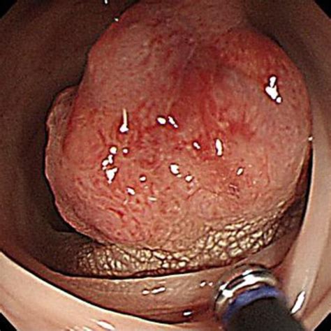 Abdominal Ct Scan Showed Swollen Regional Mesenteric Lymph Node