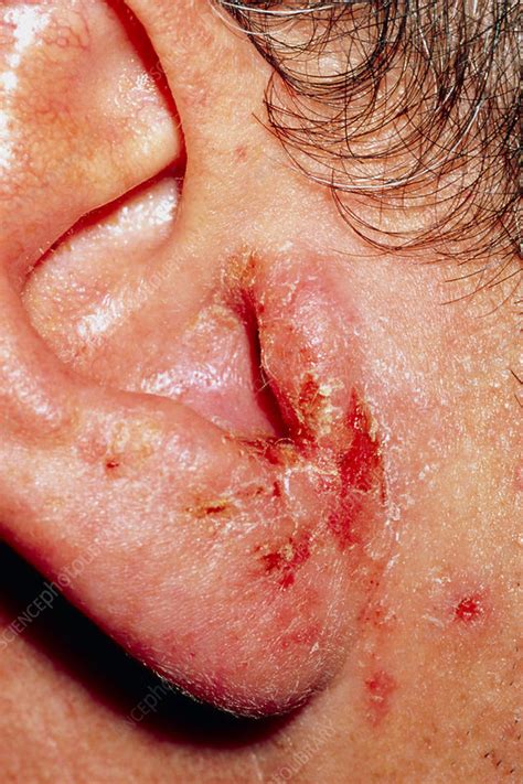 Close Up Of An Ear With Otitis Externa In An Adult Stock Image M157