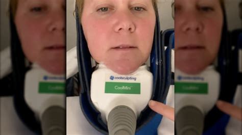 Amy Schumer S Viral Coolsculpting Video Explained By An Expert