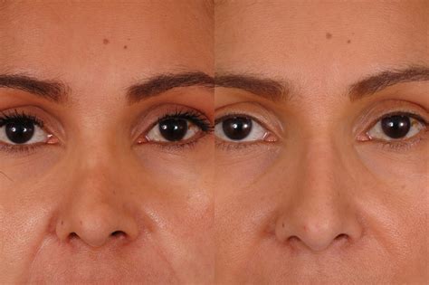 Revision Rhinoplasty Before And After Photos Dr Bassichis