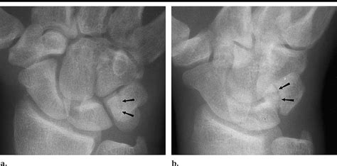 Triquetral Fracture A Pa Radiograph Of The Right Wrist