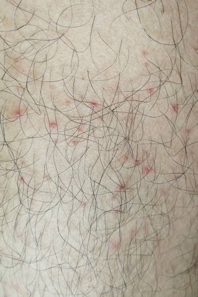 Red Blotches On Legs Stock Photos Pictures And Royalty Free Images Istock