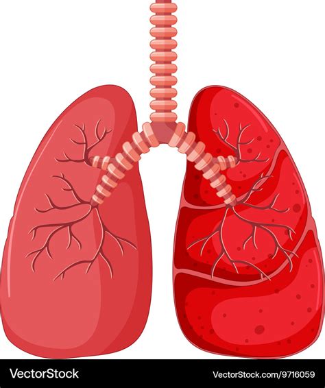 Diagram Showing Lung With Pneumonia Royalty Free Vector Hot Sex Picture