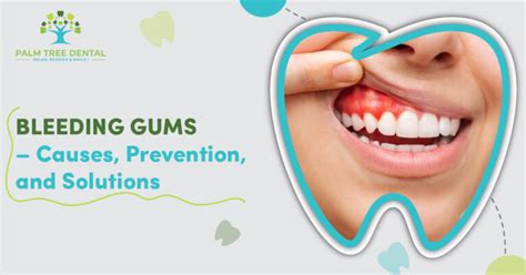 Bleeding Gums Causes Prevention And Solutions Palm Tree Dental