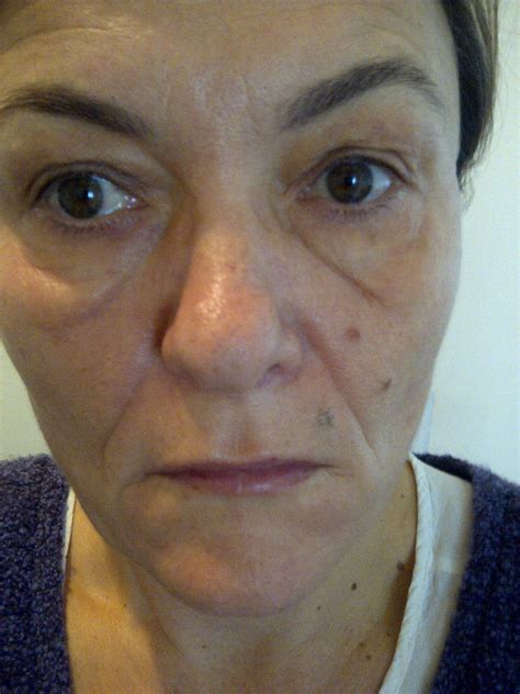 Make sure you have your drain pan in place. Hello! I have swollen bag under right eye. I took pictures