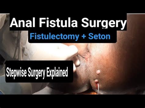 Anal Fistula Operation Fistulectomy Seton Placement Surgeon Dr Imtiaz Hussain Youtube