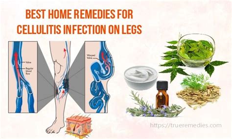 22 Best Home Remedies For Cellulitis Infection On Legs In 2020