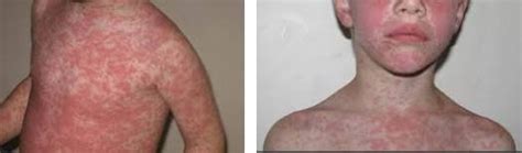 Amoxicillin Rash Pictures Adults Baby Types Treatment Prevention