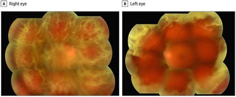 Unusual Vitreous Opacity In A Chinese Patient Ophthalmology Jama