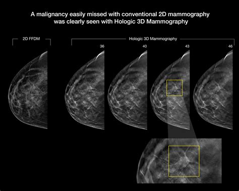 Selenia Dimensions 3D Mammography Hologic