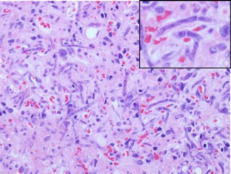 Mucormycosis is any fungal infection caused by fungi in the order mucorales. Microbiology- mycology and parasitology at Johns Hopkins ...