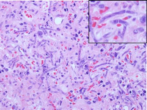 Mucormycosis and entomophthoramycosis describe infections due to the agents of the subphyla mucormycotina and entomophthormycotina, respectively. Microbiology- mycology and parasitology at Johns Hopkins ...