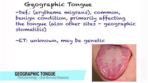 White Lesions Geographic Tongue Youtube