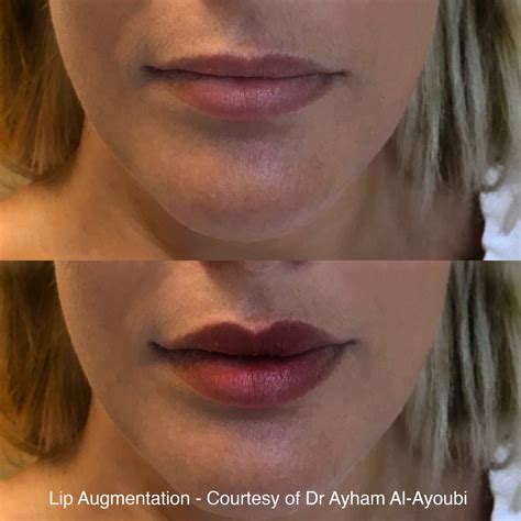 Lip Enhancement Lip Fillers Harley Street London Best Advice Reviews