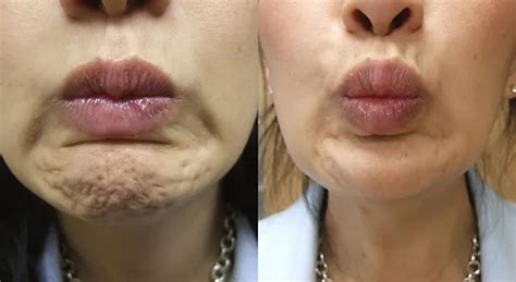 Botox Or Dysport For Your Chin Myimage Skin And Body