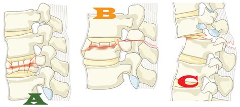 Classifications Of Thoracic Spinal Fractures Thoracic Key