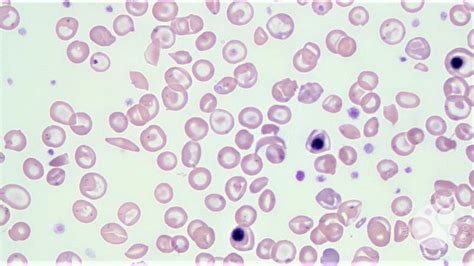 Sickle Cell Beta Thalassemia