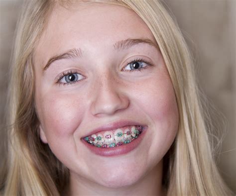 Traditional Metal Braces West Arvada Orthodontics