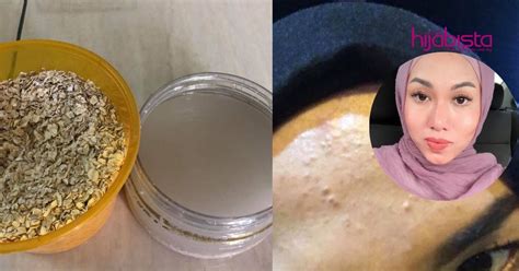 Cara hilangkan parut hitam jerawat bekas jerawat diy. Parut & Jerawat Hilang Dengan Cara Spray Oat Pada Wajah ...