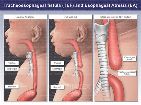 Tracheoesophageal Fistula Tef And Esophageal Atresia Ea Tri