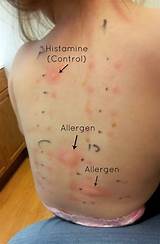 What Doctor Does Allergy Testing Images
