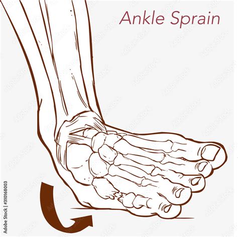 Types Of Ankle Sprains Stock Vektorgrafik Adobe Stock