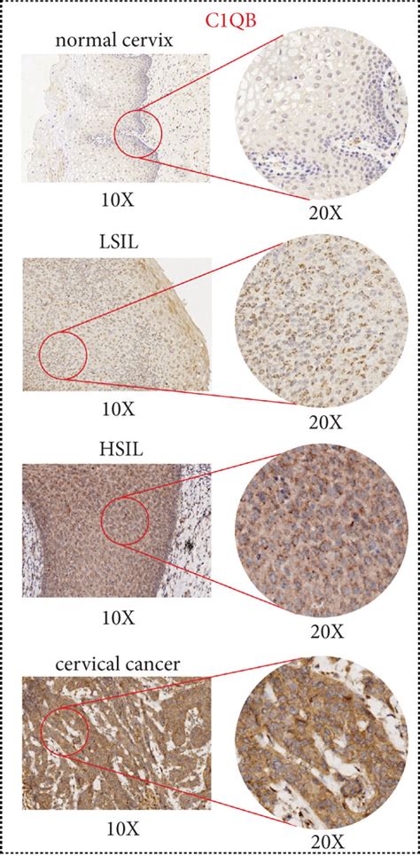 Images Of Immunohistochemical Staining In Benign Cervical Lsil Hsil
