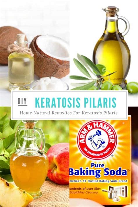 Natural Remedies For Keratosis Pilaris