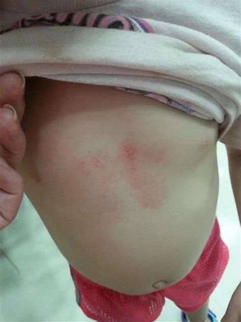 This Toddler Has Bruises On Her Chest The Reason Why This Is