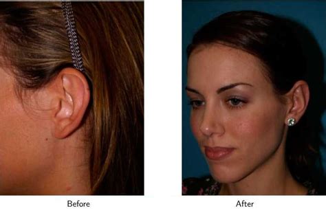 Patient 64081122 Ear Pinning Otoplasty Before And After Photos Gold Coast Plastic Surgery