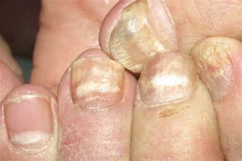 White Spots On Fingernails Dots Patches Pictures Causes Get Rid