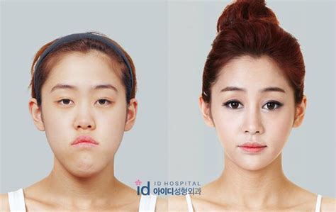 The Crazy Transformations On South Korea S Controversial Plastic