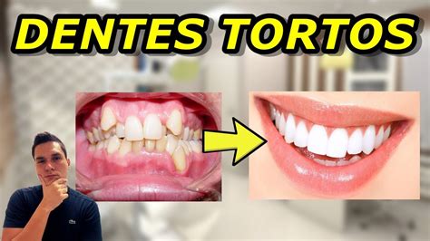 Dente Permanente Nascendo Torto