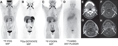 Imaging Of Pheochromocytoma And Paraganglioma Journal Of Nuclear Medicine