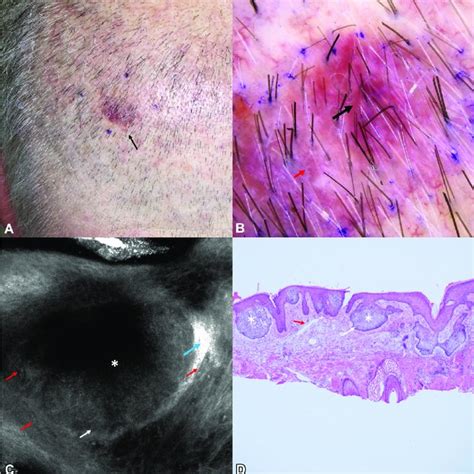 Micronodular Basal Cell Carcinoma On An H Site Showing No Download