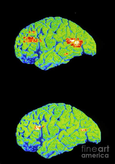 Pet Scan Of Depressed And Normal Brain Photograph By Wellcome Centre