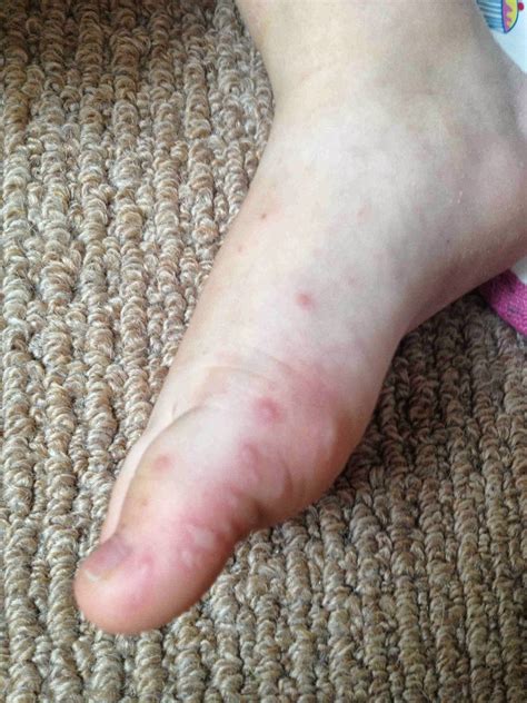 Emma In Bromley Hfmd Hand Foot And Mouth Disease
