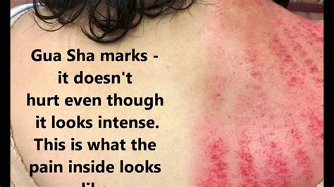 Gua sha is a traditional chinese medicine healing technique that's since been adapted into the beauty world. Gua Sha & Cupping Shoulder Pain Results - YouTube