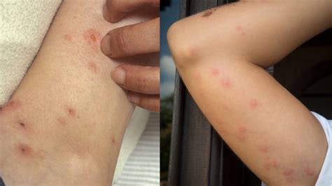 Flea Bites Vs Bed Bug Bites Differences Explained Deal With Pests