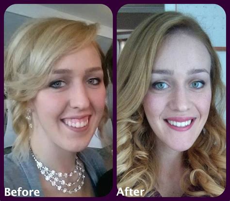 Jaw Surgery Before And After Pictures. Jaw Surgery - pictures, diet ...
