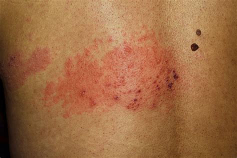 The Early Stages Of Shingles Signs And Symptoms
