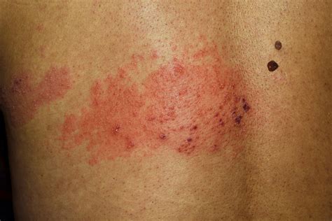 the early stages of shingles signs and symptoms