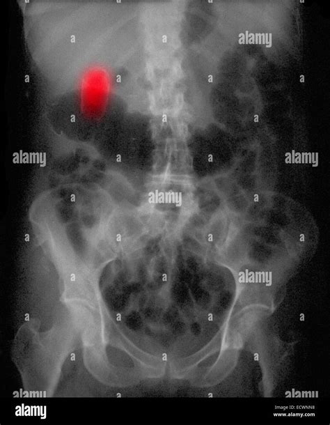 La V Sicule Biliaire Porcelaine Vu La Radiographie De L Abdomen Photo